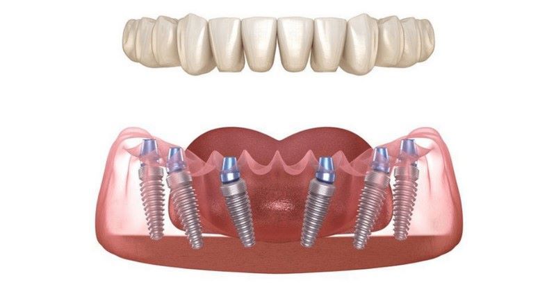 địa chỉ trồng răng implant tốt uy tín Phường Thới An TPHCM 3