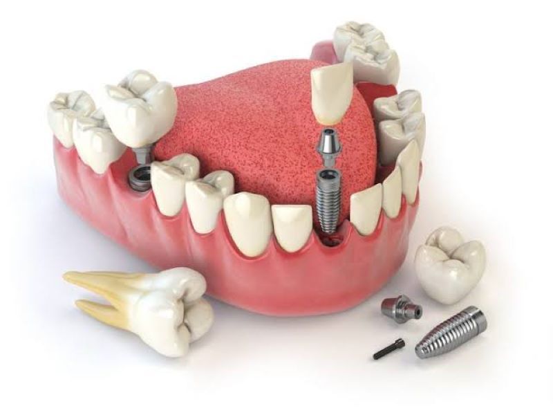 địa chỉ trồng răng implant tốt uy tín Phường Thới An TPHCM 4