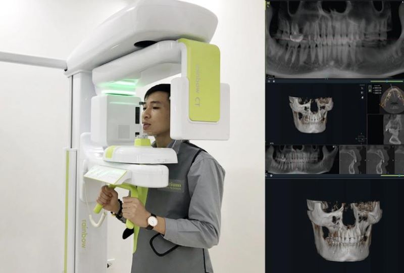 địa chỉ trồng răng implant tốt uy tín Phường An Phú Đông TPHCM 6