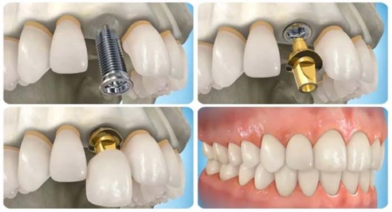 Nha khoa Hoa Hồng Phương Đông ứng dụng đa dạng kỹ thuật trồng implant