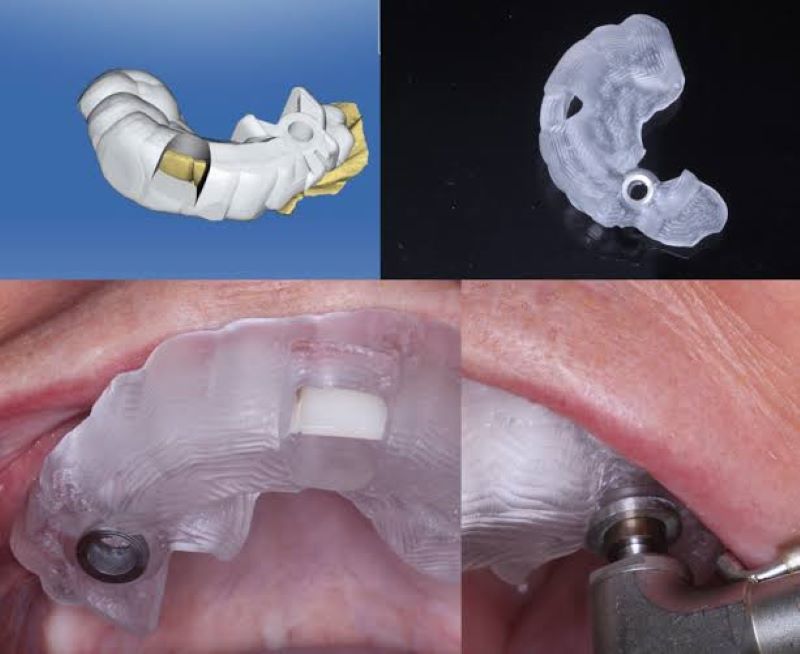 địa chỉ trồng răng implant tốt uy tín Phường An Lạc TPHCM 5