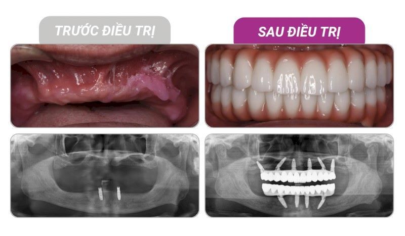 Nha khoa Tâm Đức Smile điều trị Implant phức tạp an toàn