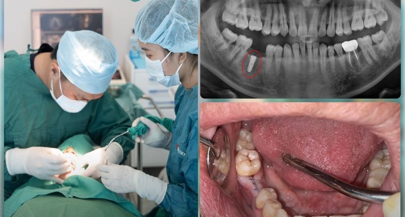 địa chỉ trồng răng implant tốt uy tín Phường Bình Tân TPHCM