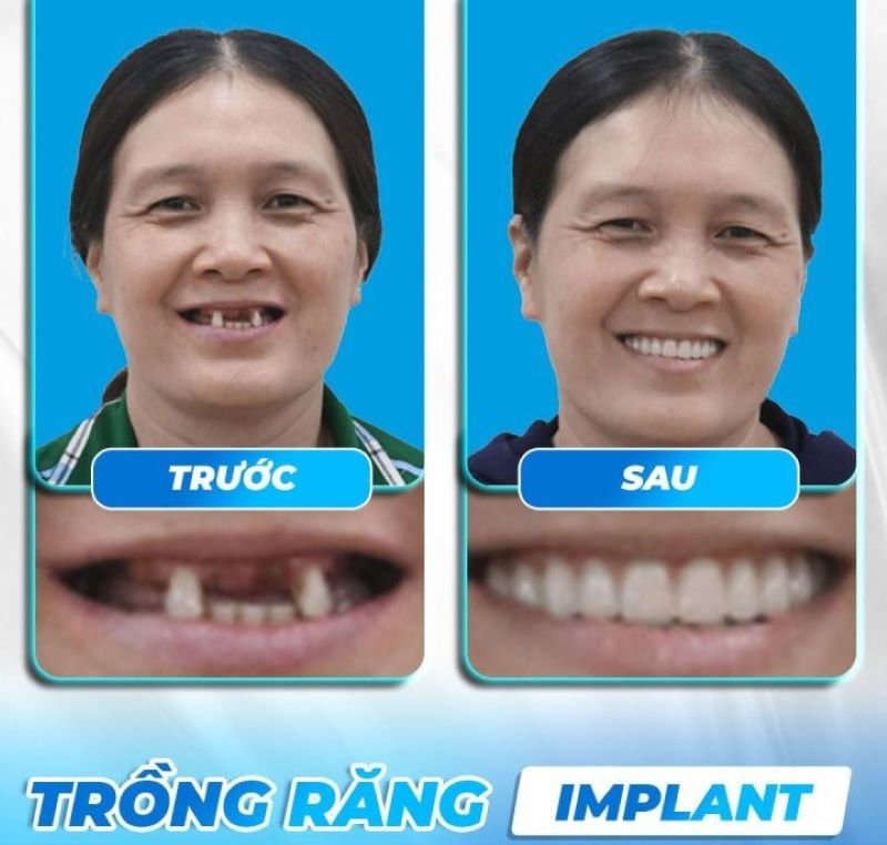 địa chỉ trồng răng implant tốt uy tín Phường Bình Tân TPHCM 5