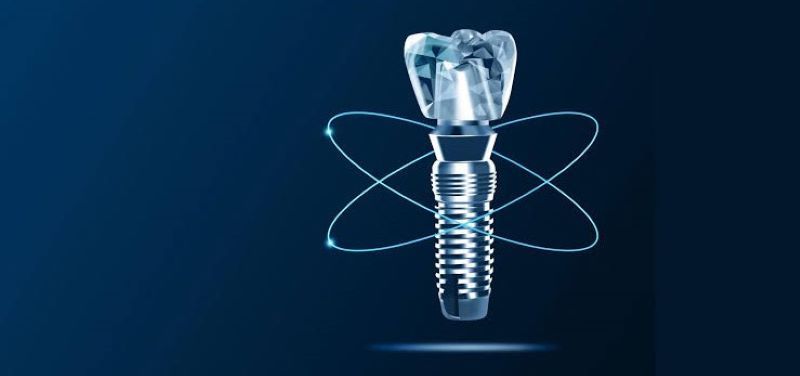 Nha khoa Paris sử dụng đa dạng dòng trụ Implant nhập khẩu