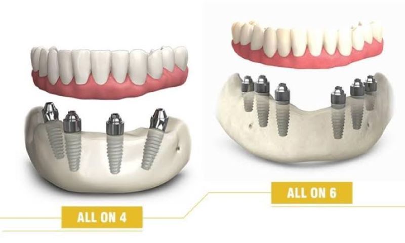 địa chỉ trồng răng implant tốt uy tín Phường Bình Trị Đông TPHCM 5