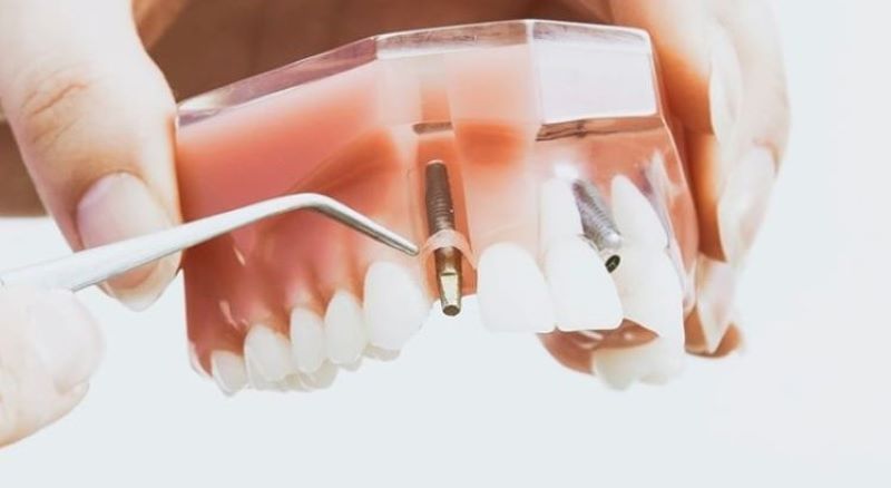 địa chỉ trồng răng implant tốt uy tín Phường Bình Trị Đông TPHCM 8