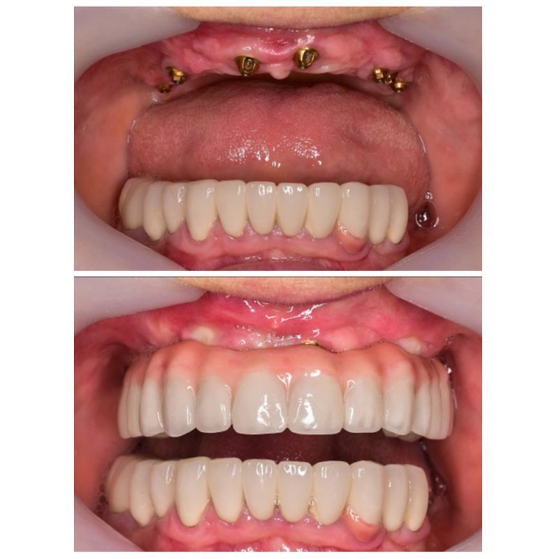Nha khoa Viva Clinic phục hình Implant thẩm mỹ bền đẹp