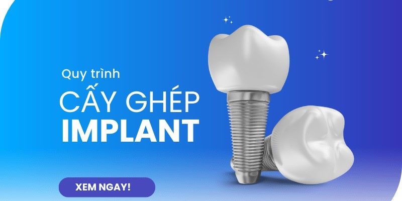Nha khoa I-DENT quy trình Implant vô trùng nghiêm ngặt