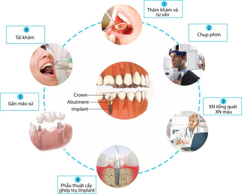 địa chỉ trồng răng implant tốt uy tín Phường Gia Định TPHCM 3