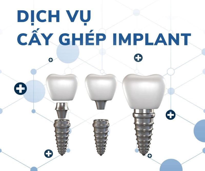 địa chỉ trồng răng implant tốt uy tín Phường Bình Thạnh TPHCM 4