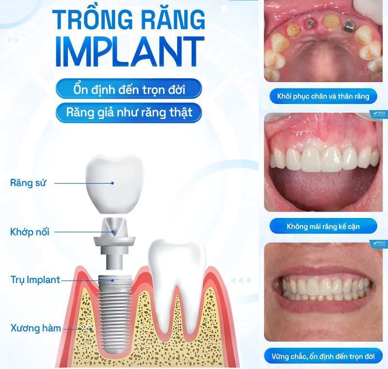 Nha khoa I-DENT cấy ghép Implant chuyên sâu, 