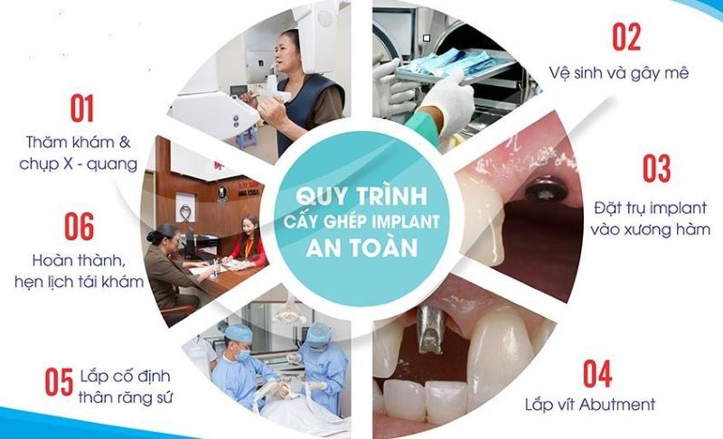 địa chỉ trồng răng implant tốt uy tín Phường Bình Lợi Trung TPHCM 2