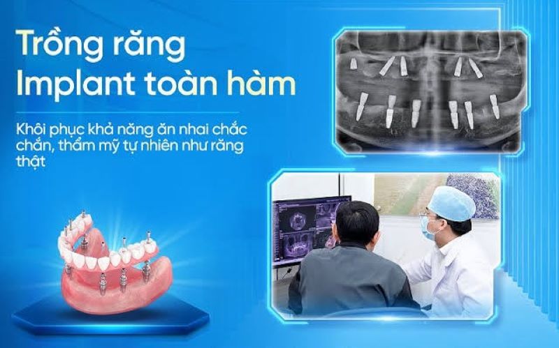 Nha khoa My Auris nổi bật với công nghệ Implant tiên tiến