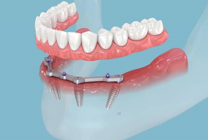 Nha khoa Viva Clinic phục hình Implant bằng vật liệu cao cấp