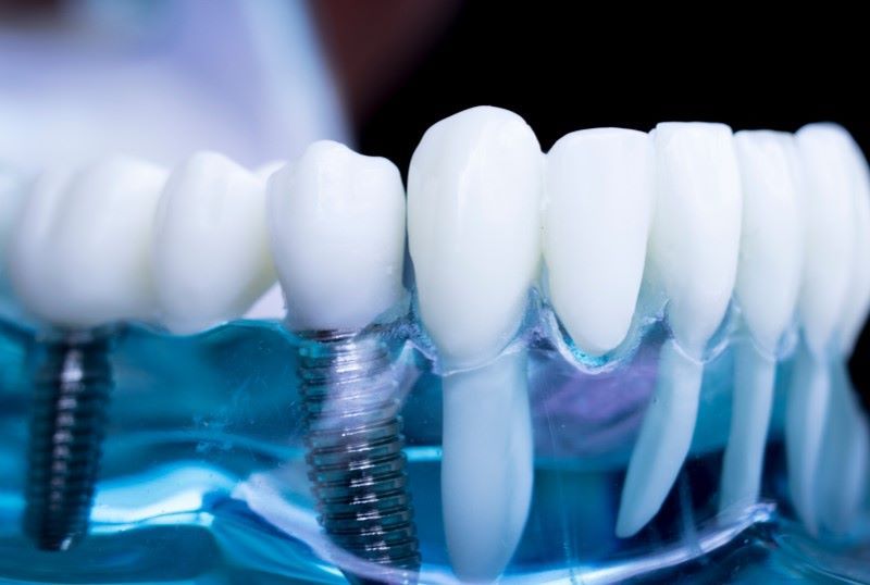 địa chỉ trồng răng implant tốt uy tín Phường Thạnh Mỹ Tây TPHCM