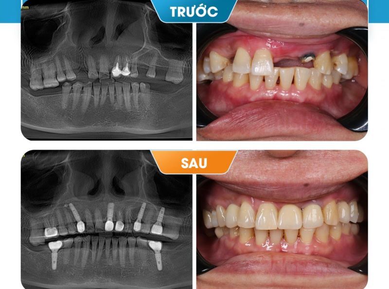 địa chỉ trồng răng implant tốt uy tín Phường Thạnh Mỹ Tây TPHCM 2