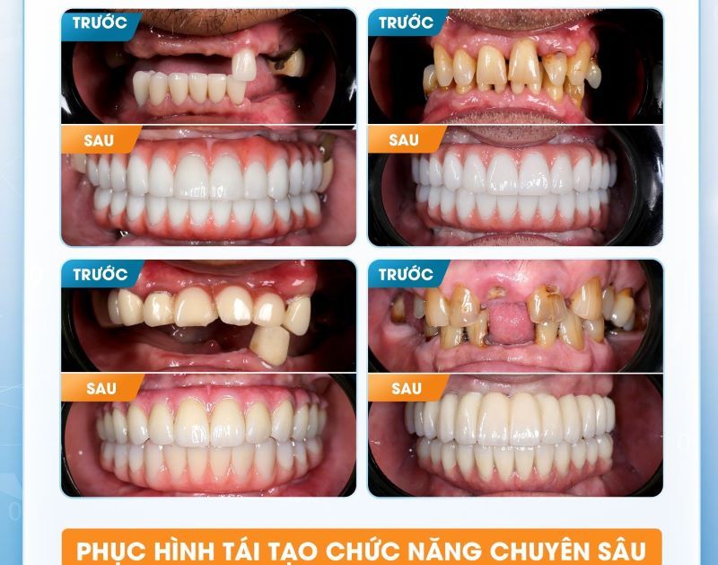 địa chỉ trồng răng implant tốt uy tín Phường Bình Quới TPHCM 3