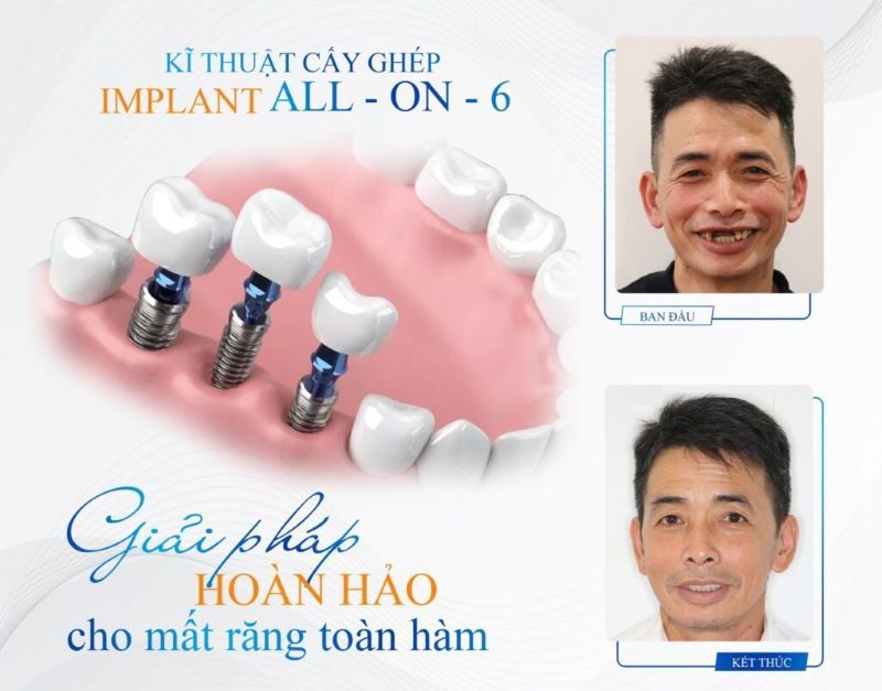 địa chỉ trồng răng implant tốt uy tín Phường Bình Quới TPHCM5