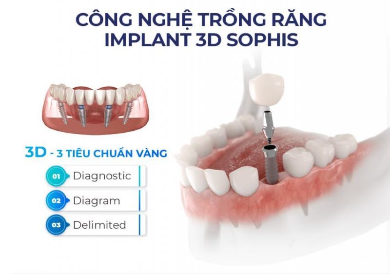 địa chỉ trồng răng implant tốt uy tín Phường Hạnh Thông TPHCM 3