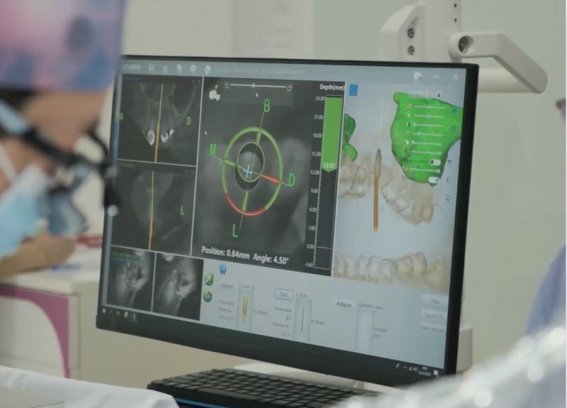 địa chỉ trồng răng implant tốt uy tín Phường An Nhơn TPHCM 3