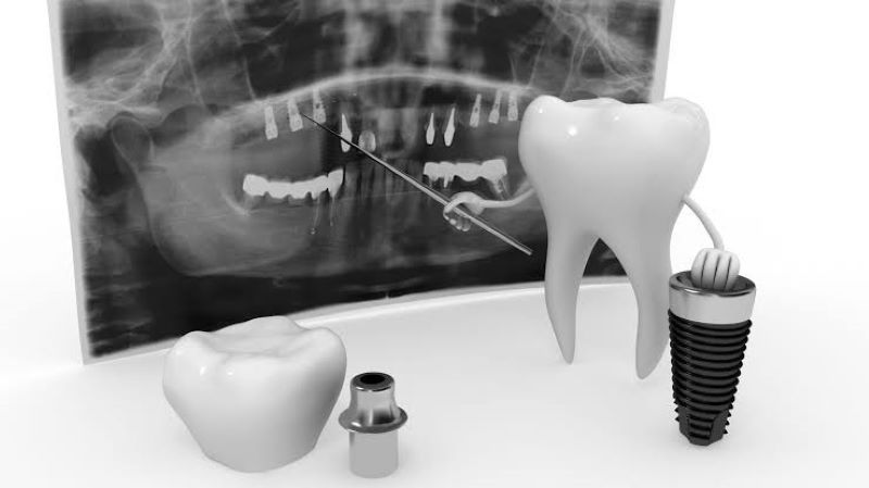 Việt Smile cung cấp dịch vụ Implant công nghệ cao