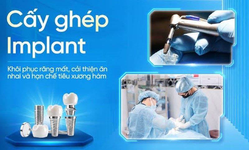 địa chỉ trồng răng implant tốt uy tín Phường Thông Tây Hội TPHCM