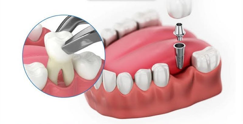 Nha khoa Quốc tế Newgate phục hình Implant thẩm mỹ