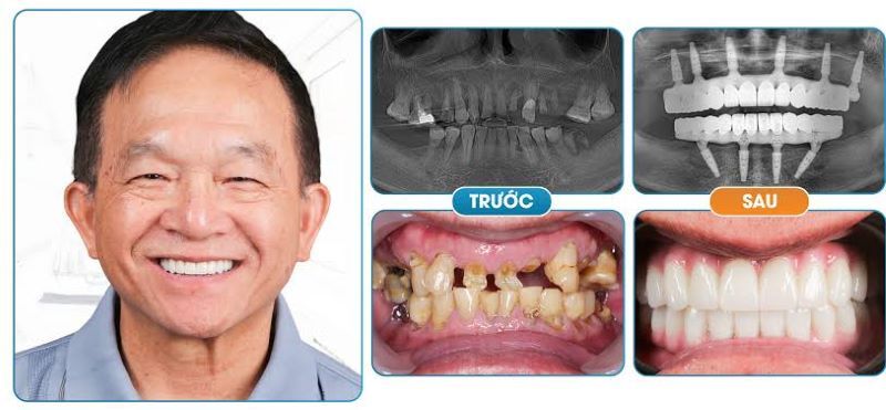 Dr.Care Implant Clinic chuyên sâu điều trị Implant cho khách hàng trung niên