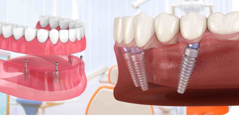 Worldwide cung cấp nhiều phương pháp Implant chuyên sâu theo nhu cầu