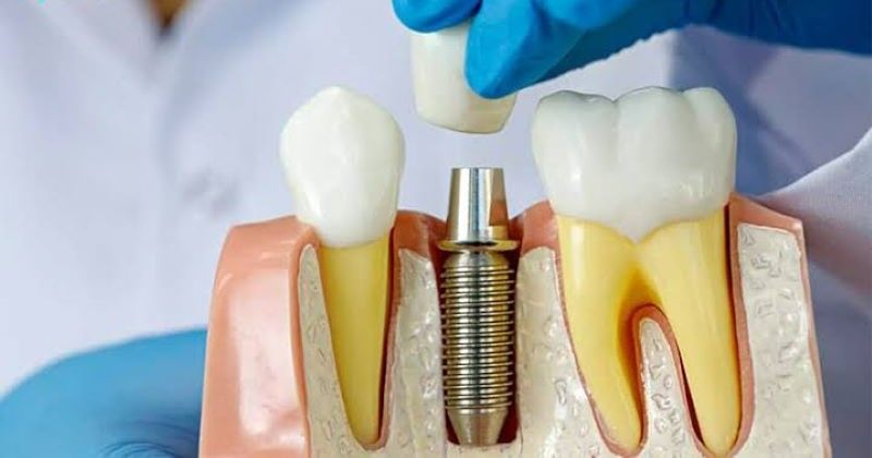 địa chỉ trồng răng implant tốt uy tín Phường Đức Nhuận TPHCM