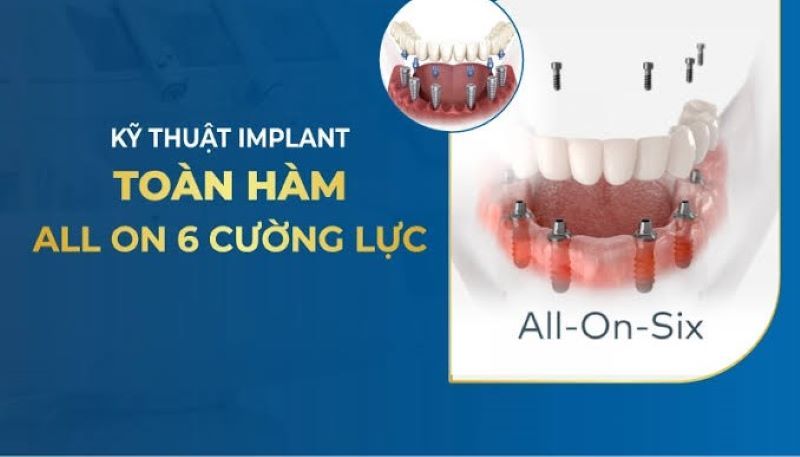 địa chỉ trồng răng implant tốt uy tín Phường Đức Nhuận TPHCM 4
