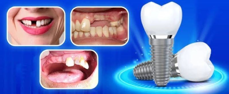 Nha khoa Berlin Dentist luôn cam kết cấy ghép Implant an toàn nhanh chóng
