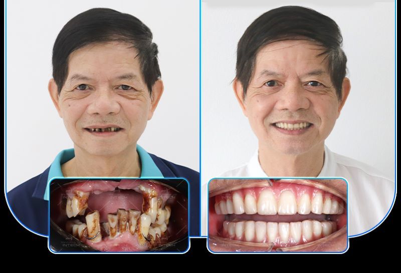 địa chỉ trồng răng implant tốt uy tín Phường Phú Nhuận TPHCM 4