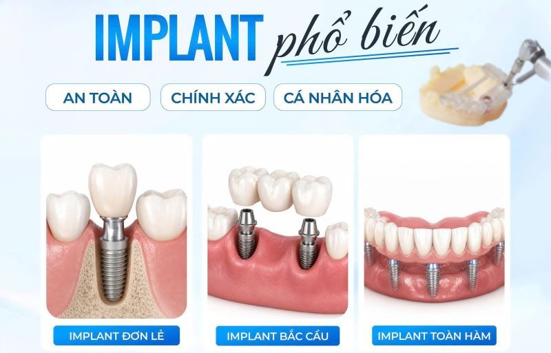 Nha khoa Berlin Dentist cấy ghép Implant công nghệ tiên tiến