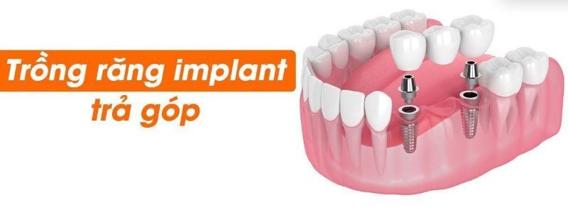 địa chỉ trồng răng implant tốt uy tín Phường Tân Sơn Hòa TPHCM 2