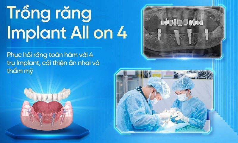 địa chỉ trồng răng implant tốt uy tín Phường Tân Sơn Hòa TPHCM 4