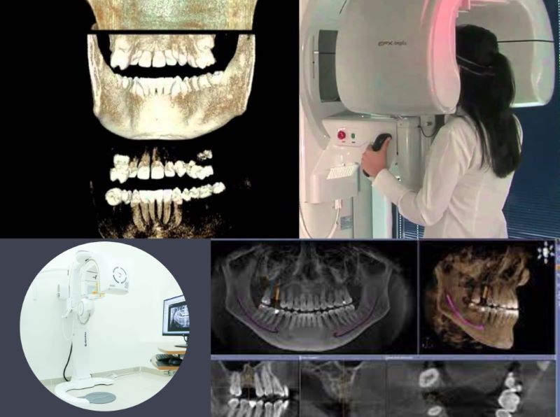 Nha khoa Bảo Việt ứng dụng scan kỹ thuật số trong cấy Implant