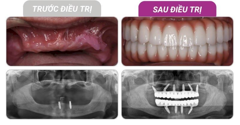 Nha khoa Thùy Anh nhiều kinh nghiệm điều trị Implant phức tạp