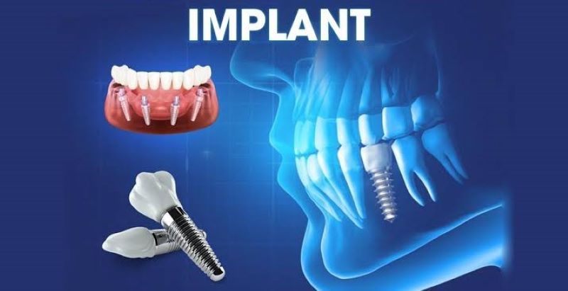 Nha khoa Gova nổi bật với công nghệ Implant 3D Sophis