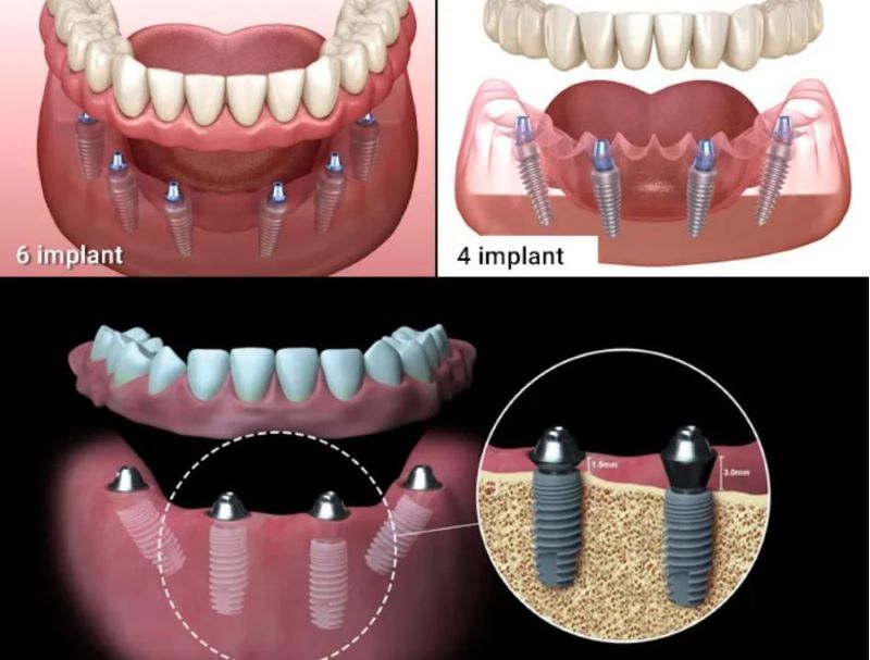 Nha khoa Tâm Đức Smile nổi bật phục hồi Implant toàn hàm