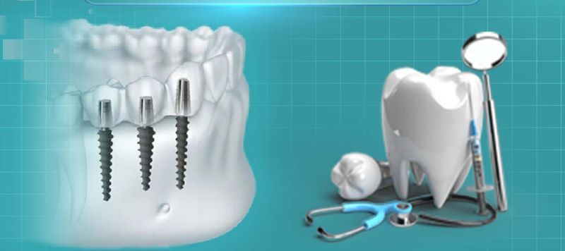 địa chỉ trồng răng implant tốt uy tín Phường Tân Hòa TPHCM 4