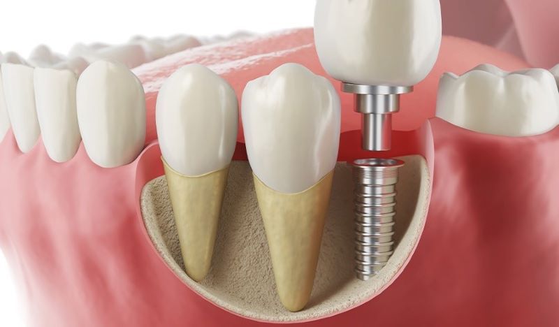 Nha khoa Trí Việt có nhiều năm kinh nghiệm cấy ghép Implant