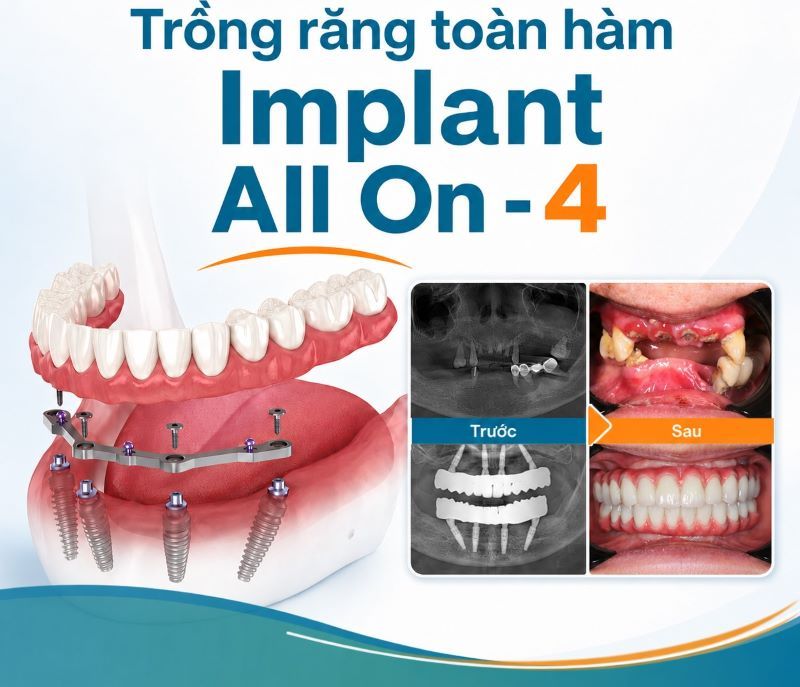 địa chỉ trồng răng implant tốt uy tín Phường Bảy Hiền TPHCM 3