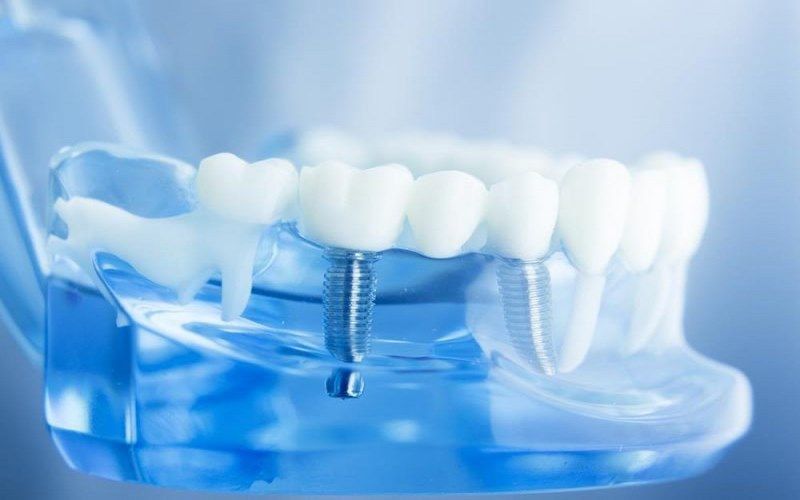 địa chỉ trồng răng implant tốt uy tín Phường Tân Sơn TPHCM 2