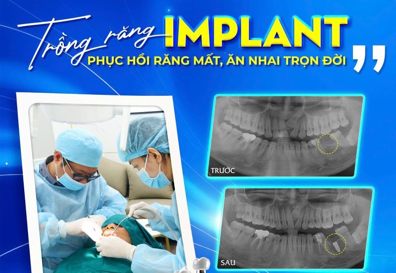 Nha Khoa Nam Anh chuyên phục hình Implant cho răng bị mất