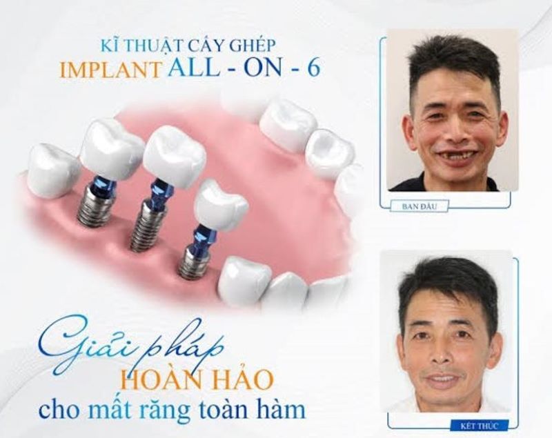 địa chỉ trồng răng implant tốt uy tín Phường Tây Thạnh TPHCM 3