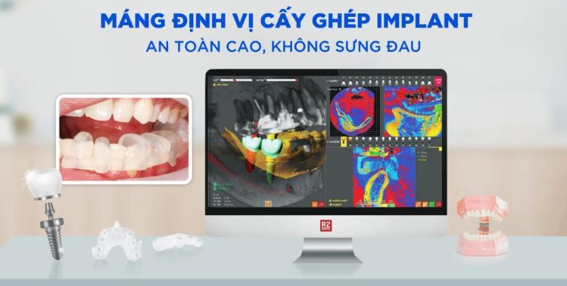 địa chỉ trồng răng implant tốt uy tín Phường Tây Thạnh TPHCM 4
