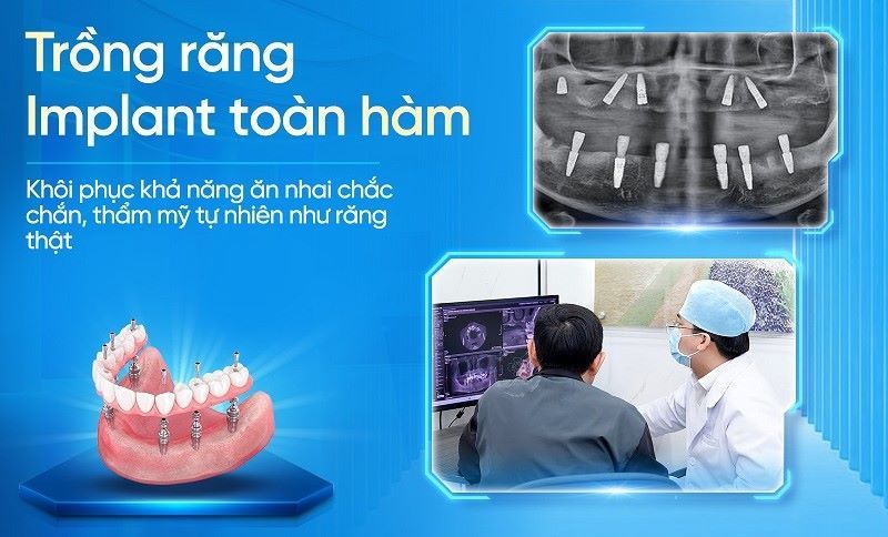 địa chỉ trồng răng implant tốt uy tín Phường Tân Sơn Nhì TPHCM