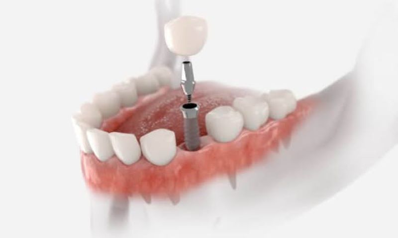 địa chỉ trồng răng implant tốt uy tín Phường Tân Sơn Nhì TPHCM 3